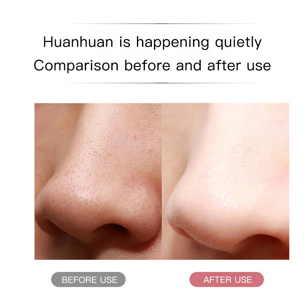 Limpiador ultrasónico de poros, exfoliante, eliminador de puntos negros, limpieza facial profunda, limpiador facial ultrasónico con pala iónica.